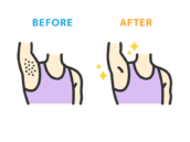 ワキ脱毛の、ビフォーアフターのアイコン（線画カラー）の無料イラスト